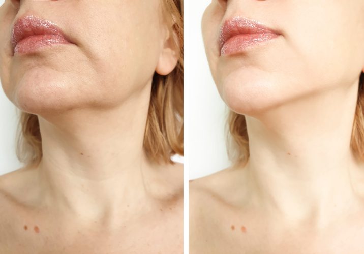 Woman,Tightening,The,Chin,Before,And,After,The,Procedure